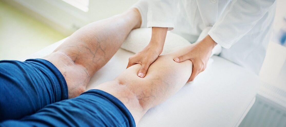 kŕčové žily na nohách a ich liečba